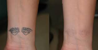 Make sure you don't hurt yourself. Going For Tattoo Removal Know The Essentials Prior To The Treatment Information Hub 9