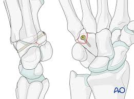 Image result for Hamate Bone