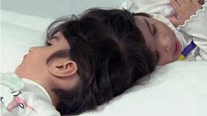 A longa batalha dos médicos para separar irmãs siamesas ligadas pela cabeça 