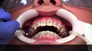 A simple way to get some braces pain relief is to rub an oral anesthetic like orajel or anbesol directly on the sensitive teeth and gums. Getting Braces How Youtube