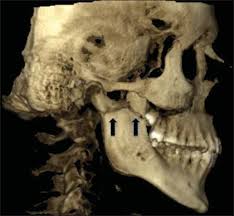 Image result for Coronoid Process Fracture