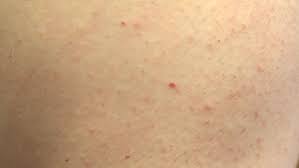 Leucemia manchas rojas en la piel. Puntos Rojos En La Piel Que Son Y Por Que Aparecen
