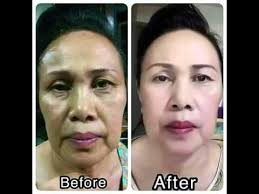 Cara menghilangkan jerawat dengan masker kulit telur merupakan cara ampuh yang pertama untuk memberantas bintik hitam bekas jerawat. Cara Mudah Hilangkan Jerawat Jeragat Dan Bintik Hitam Youtube