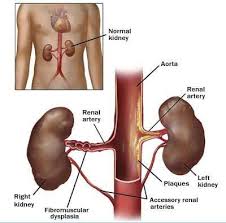 Renal Artery Doppler Sonographic Tendencies In 2020 Renal Chronic Renal Disease Kidney Failure Causes