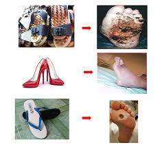 Klinikal yang diterbitkan dalam jurnal diabetes care pada tahun 2003 menunjukkan bahawa kulit kayu manis mengurangkan kadar glukosa darah dan kolesterol pada orang dengan diabetes jenis 2, dan boleh mengurangkan faktor. Cara Memilih Kasut Bagi Pesakit Kencing Manis