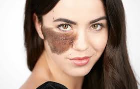 A New Beginning: Cosmetic Surgery's Impact on Birthmark Removal - Tampa  Liposuction Specialty Clinic | Body Contouring Florida