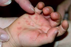 Hfmd most commonly affects children under 10 years of age. Hand Foot And Mouth Disease How It Can Affect Your Family