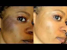 We did not find results for: How To Treat Sunburn Fast And Restore Your Dark Skin Best Sunburn On Face Sunburn Face Natural Remedies For Sunburn