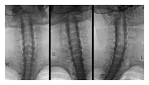 Myelography In The Age Of Mri Why We Do It And How We Do It