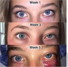 Image result for Proptosis