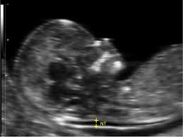 increased fetal nuchal translucency thickness and normal