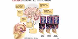 Depresi dan kecemasan biasanya terjadi secara bersamaan. Memahami Kepribadian Dua Kutub Bipolar Kompasiana Com