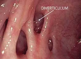 Image result for Diverticulitis