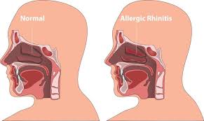 Image result for Rhinitis