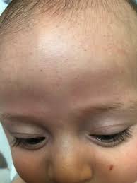 Our skin is prone to rashes, blemishes, and bumps of all kinds. Little Red Dots On Face March 2018 Babies Forums What To Expect