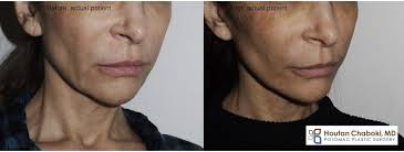 Check spelling or type a new query. Nonsurgical Facelift With Threads