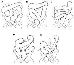 Dolichocolon Revisited An Inborn Anatomic Variant With Redundancies Causing Constipation And Volvulus