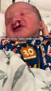 Craniofacial Acceptance Month: Advocating for Awareness