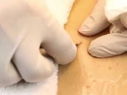 Ingrown hairs are a common consequence of the hair removal process, whether through shaving or waxing.medically referred to as pseudofolliculitis, an ingrown hair occurs when a hair curls back into the skin during the growth process and pierces it, usually causing inflammation.our skin has an immune system on its own outside of our regular immune system, explains edidiong kaminska, m.d., mbs. Ingrown Hair Removal Treatment Manhattan Ny Ingrown Hair