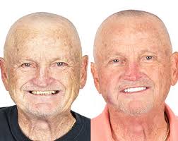 Dental health council offers a great list of low income dental clinics in detroit. Affordable Senior Dental Implants Dream Dental Implants