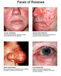 Image result for demodex rosacea