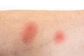 Image result for mosquito bite