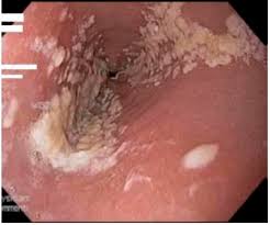 Read more about symptoms, diagnosis, treatment. Possible Risk Factors For Candida Esophagitis In Immunocompetent Individuals Nassar Gastroenterology Research
