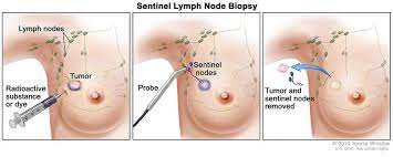 An effected lymph node, will feel like a hard, rubbery lump under your dog's skin. Lymph Node Removal In Early Stage Breast Cancer National Cancer Institute