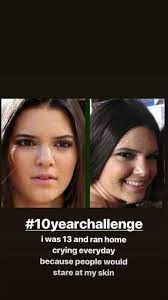 Maybe you would like to learn more about one of these? Kendall Jenner Acne She Gets Real About Dealing With Spots Glamour Uk