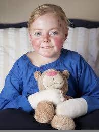 Epidermolysis bullosa: Disease is 'worst you've never heard of'