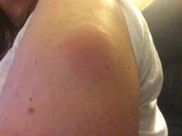 Tdap Reaction Question December 2014 Babies Forums What To Expect