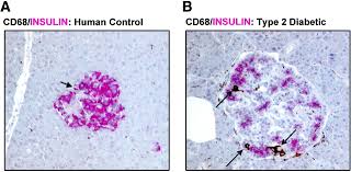 Maybe you would like to learn more about one of these? Islet Inflammation In Type 2 Diabetes Diabetes Care