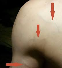 Der serbe darf bis auf weiteres keinen kontaktsport ausüben. Bayerisches Arzteblatt