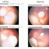 More cancer signs and symptoms. 1