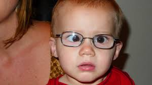 Learn about strabismus, or crossed eyes, from cleveland clinic. Before And After Eye Muscle Surgery Photos Sarasota Bradenton Florida
