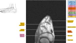 Epidemiology of tuberculosis etiology tuberculous spondylodiscitis clinical manifestations review of imaging findings: Mri Of The Foot Radiology Key