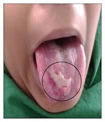 Image result for lichen planus on tongue)