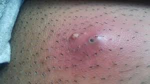 I think it started as an ingrown hair and i messed with it and messed you may have an ingrown hair that has turned into a sebaceous cyst. Ingrown Hair Cyst Treatments Causes And Prevention