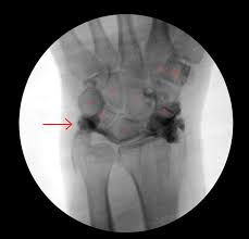 Ulnar Impaction Syndrome. : R/Radiology