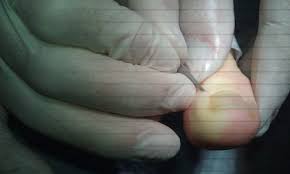 Image result for Akutní zánět nehtového lůžka