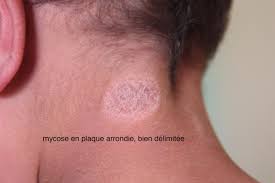 Mycose de la peau vésiculeuse. Dermato Info Les Mycoses Cutanees