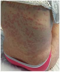 Image result for pruritic urticarial papules and plaques of pregnancy