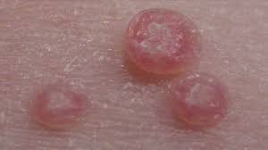 Apply the paste on the affected area, and leave it on for at least 3 to 4 hours. How To Treat Molluscum Contagiosum Youtube
