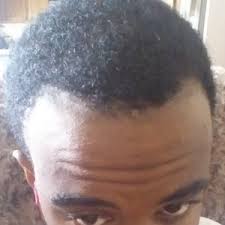 We're not talking about a prince charles or, god forbid, donald trump haircut here. 25 Black Male Embarrassed My Hair Is Thinning And Hairline Receding What Are My Options Photo