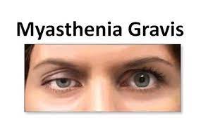 Helping you understand, manage and talk about. Ø§Ù„ÙˆÙ‡Ù† Ø§Ù„Ø¹Ø¶Ù„ÙŠ Ø§Ù„ÙˆØ®ÙŠÙ… Myasthenia Gravis