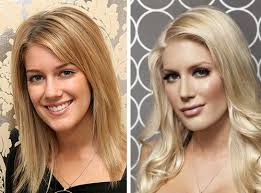Pin On Botox Before After