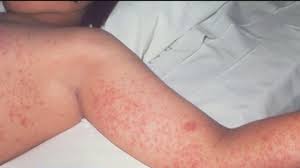 Dallas County confirms first measles case of 2025