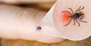 Transmise lors d'une piqûre de tique, elle peut. Maladie De Lyme Etes Vous Malade Ou Fou