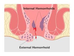 Image result for Hemorrhoid
