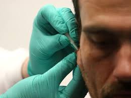 Battlefield acupuncture gives veterans alternative to drugs for pain relief 